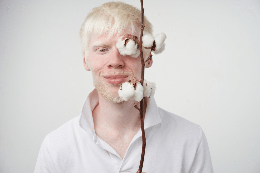 Czym Jest Albinizm Poznaj Przyczyny Tej Choroby Zdrowe Zdrowie Hot